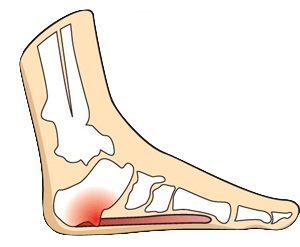 Untreated heel clearance spurs